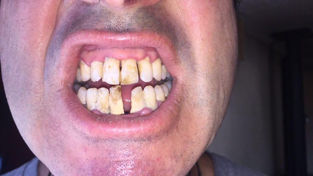 Robert mouth before turmeric and gum disease treatments