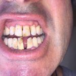 Rob’s gums before turmeric teeth gums help