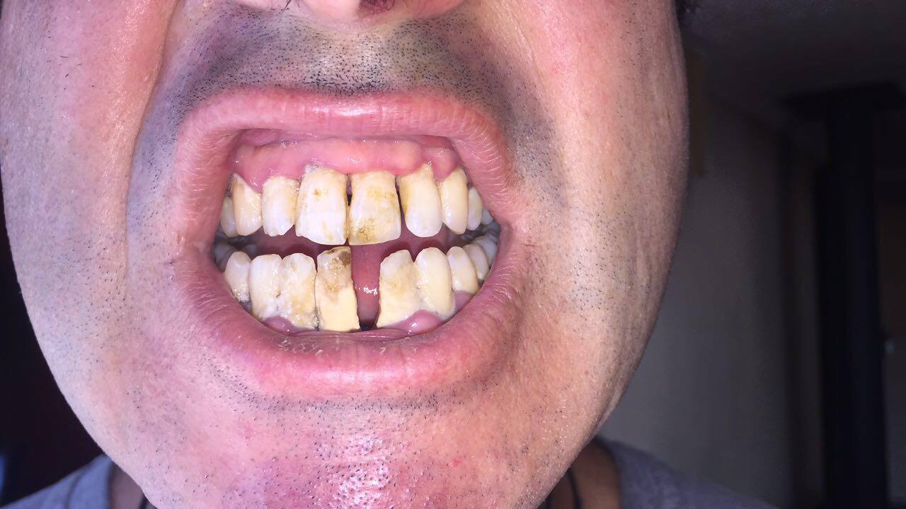 Why You Should Start Using Turmeric For Gum Disease Instantly