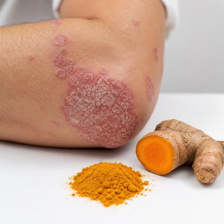 Turmeric for Psoriasis 2026: The Evidence for Curcumin and Autoimmune Skin Conditions